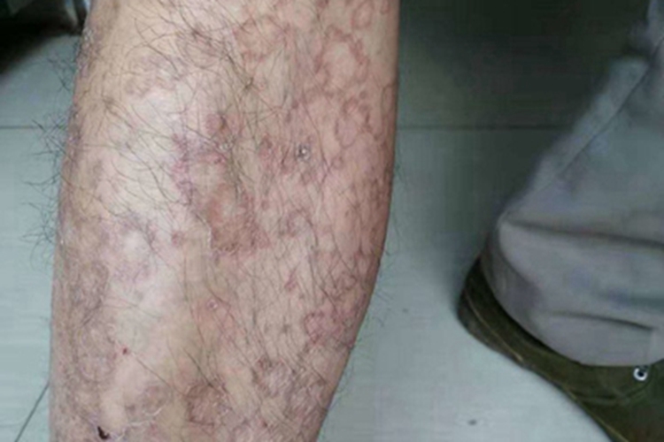 可变性红斑角化症小腿红褐色斑图