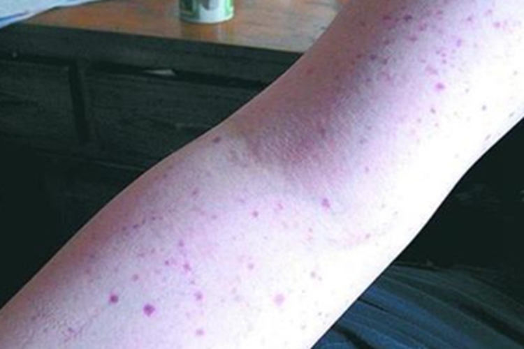 过敏性紫癜胳膊有紫色斑点图 过敏性紫癜胳膊有紫色斑点图