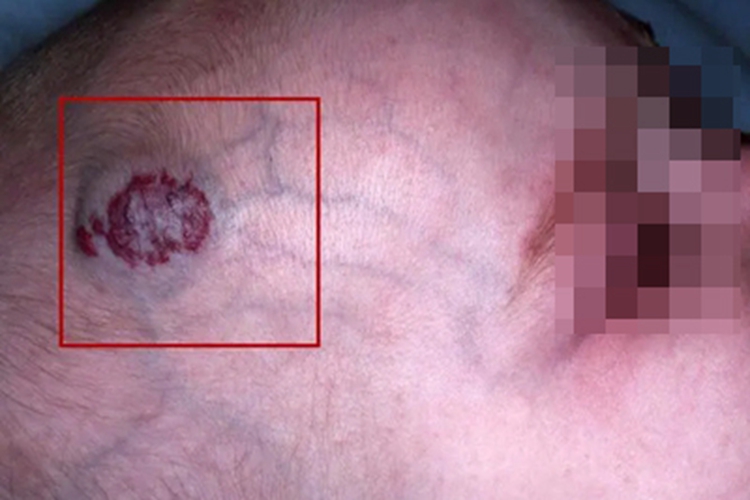 蔓状血管瘤头部肿块图 蔓状血管瘤头部肿块图