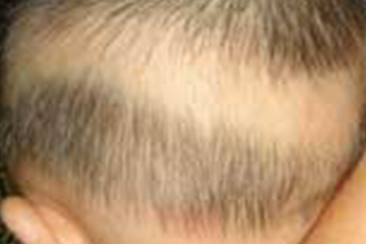 佝偻病宝宝枕秃图