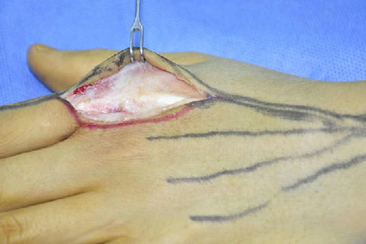 手指肌腱松解术切口及松解图 手指肌腱松解术切口及松解图