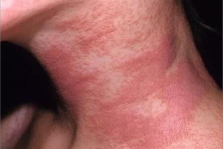 日光性皮炎侧颈红斑图 日光性皮炎侧颈红斑图