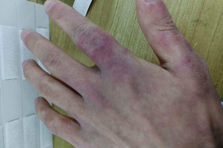 冻疮手指症状图