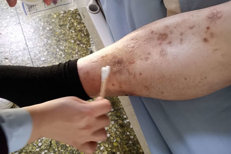 糖尿病性大疱病图 糖尿病性大疱病图