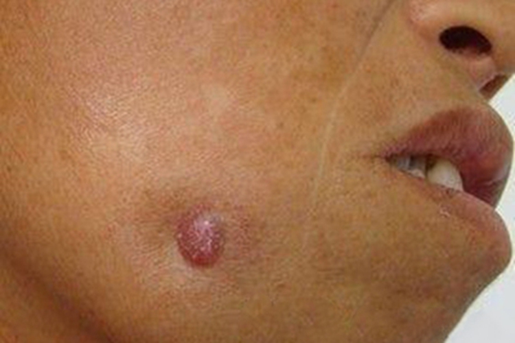 瘢痕疙瘩性芽生菌病面部症状图 瘢痕疙瘩性芽生菌病面部症状图