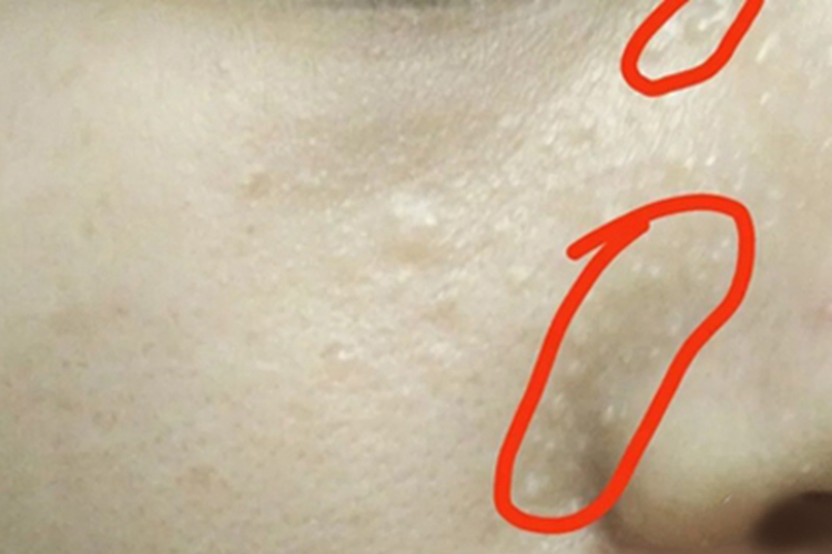 多发性毛发上皮瘤鼻唇沟症状图