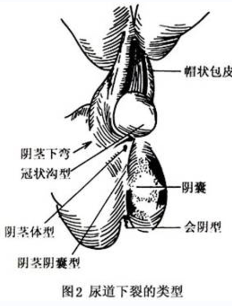 尿道下裂阴囊型图片