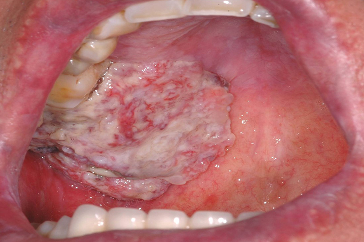 口腔扁平苔藓癌变图 口腔扁平苔藓癌变图