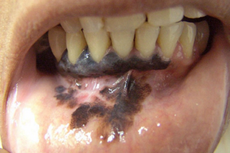 恶性黑色素瘤唇内侧症状图