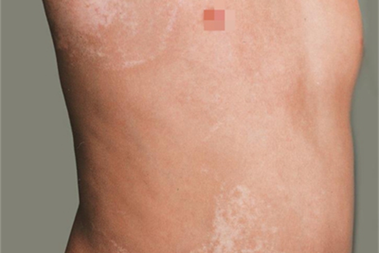 脱色性色素失禁症斑图