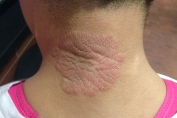 神经性皮炎颈部皮肤增厚图 神经性皮炎颈部皮肤增厚图