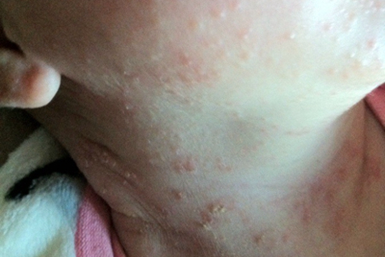 渗出型婴儿湿疹颈部症状图