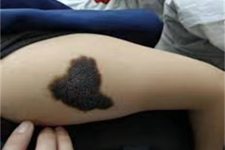 浅表播散型黑色素瘤胳膊长黑斑图 浅表播散型黑色素瘤胳膊长黑斑图