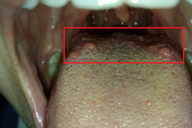 舌背部叶状乳头炎图 舌背部叶状乳头炎图