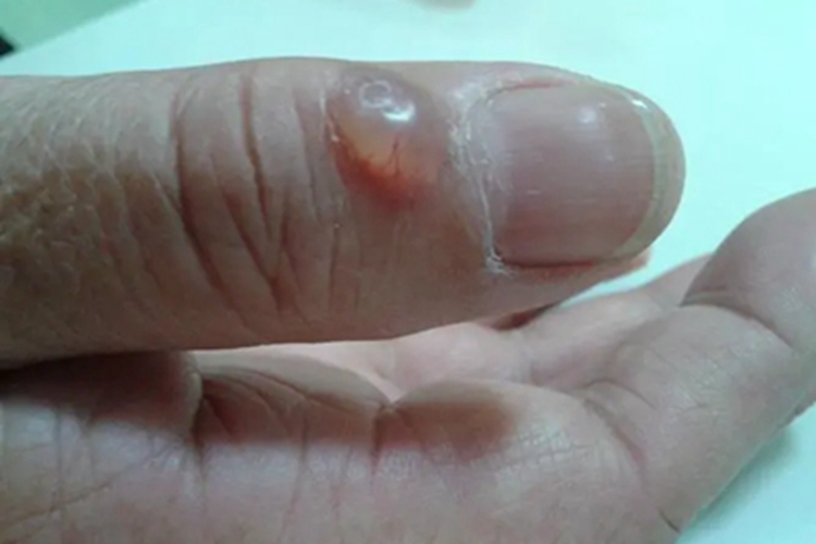 黏液样囊肿手指软疙瘩图