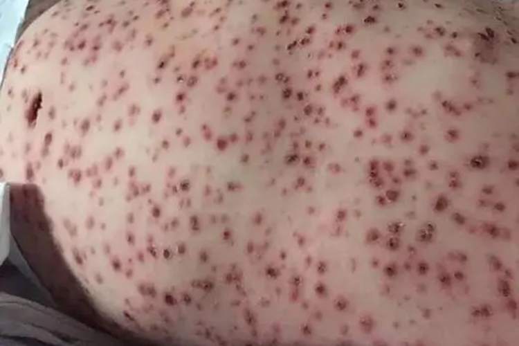 水痘进行性弥漫性水痘疹图