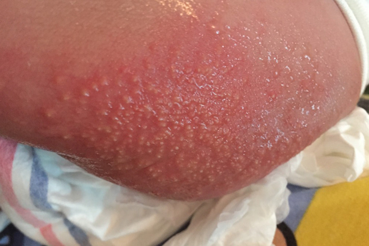 小孩屁股急性湿疹图