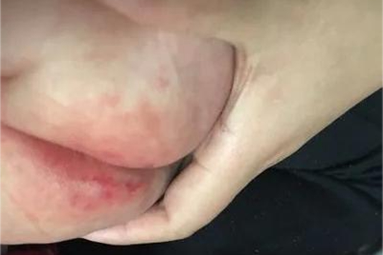 婴儿尿布疹屁股起红斑图