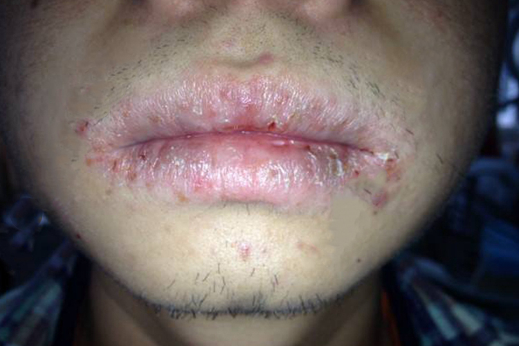 浅表化脓性腺性唇炎图