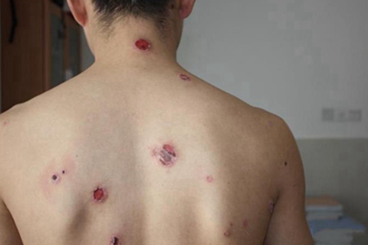 男性三期梅毒背部结痂图