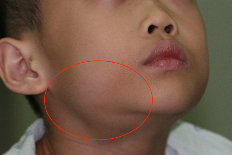 唾液腺结石发炎图