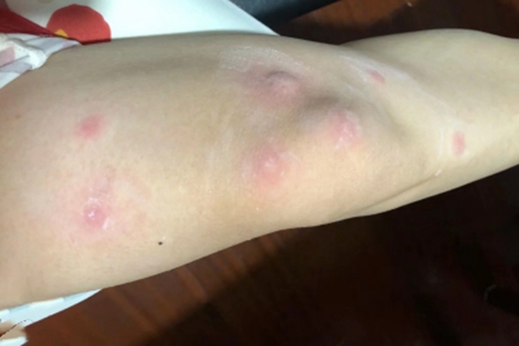 螨虫皮炎大腿很多红斑图