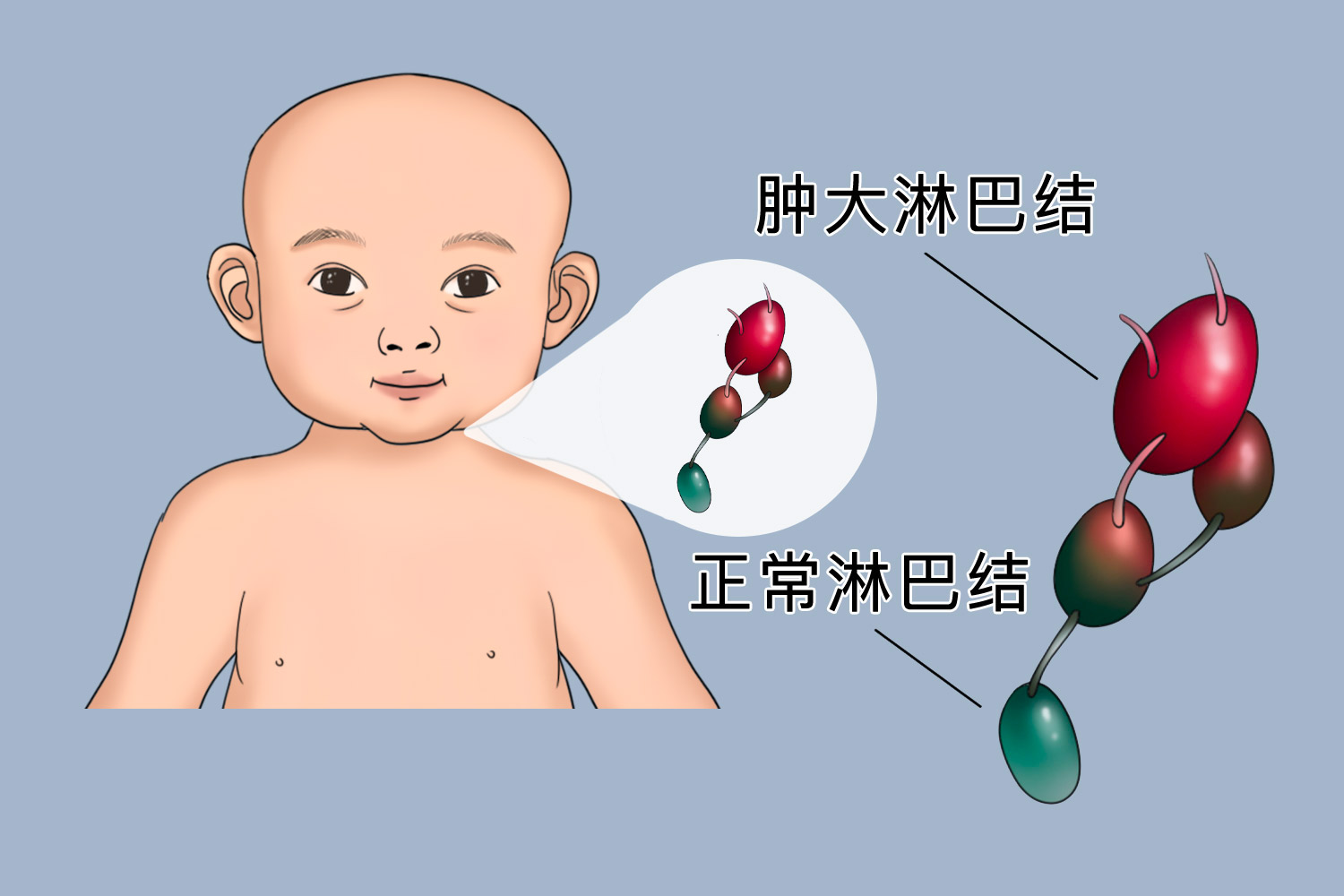 8个月婴儿淋巴结形态图