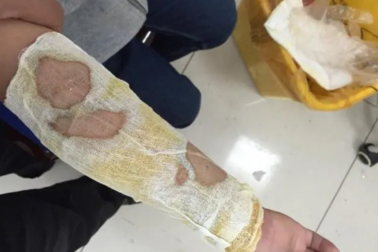 小孩胳膊烫伤脱皮包扎图
