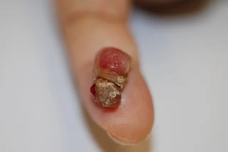 毛发肉芽肿手指疙瘩图