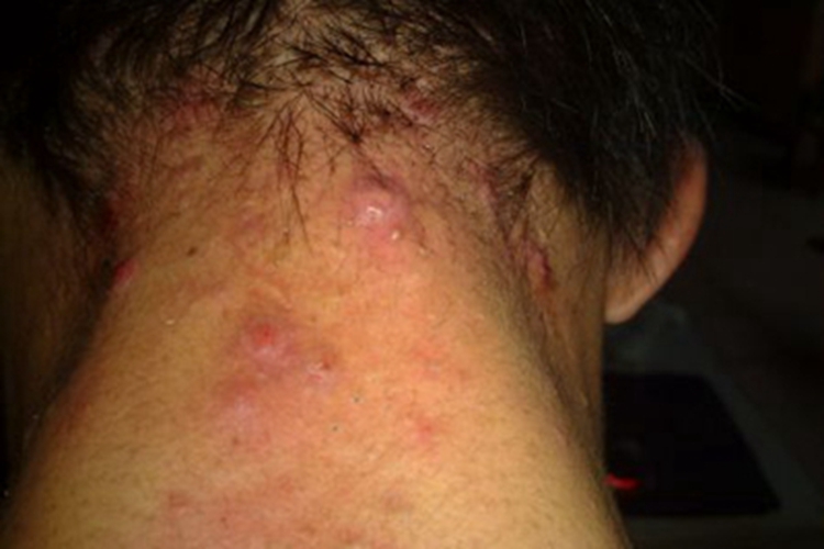 嗜酸性脓疱性毛囊炎后颈红斑图