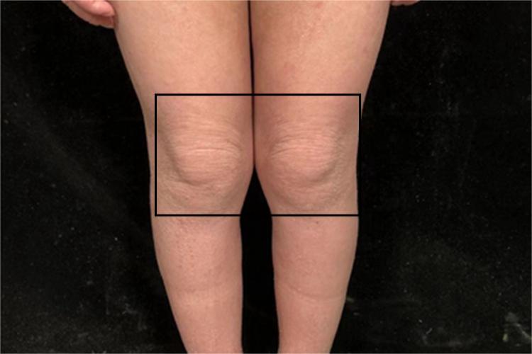 特应性皮炎腿部皮肤粗糙图