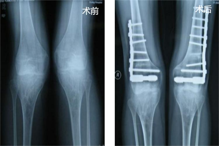 股骨髁上截骨矫形术影像图