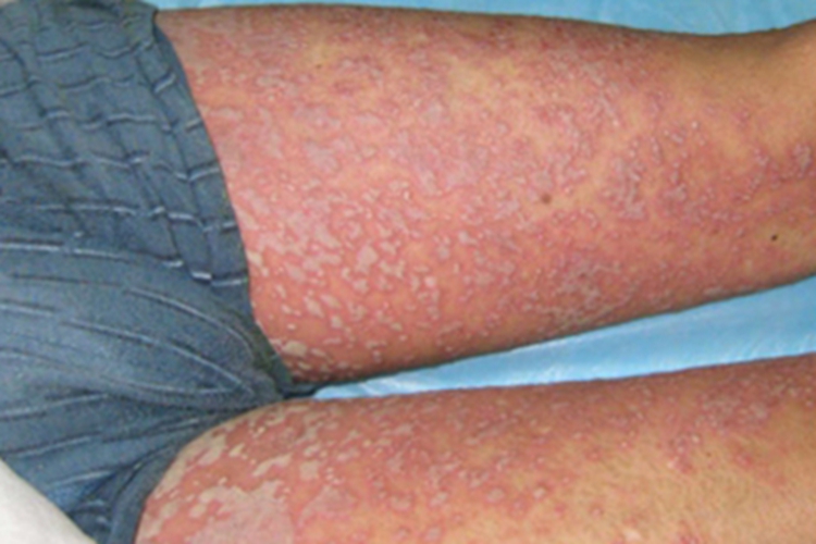 脓疱性肢端皮炎大腿脓包图 脓疱性肢端皮炎大腿脓包图