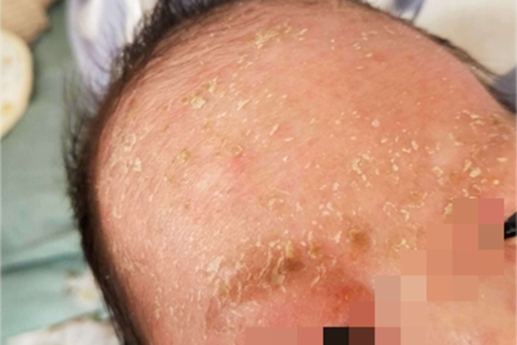 脂溢型婴儿湿疹黄痂图 脂溢型婴儿湿疹黄痂图