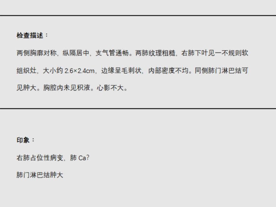 胡晓晨-小细胞肺癌（黄女士确诊小细胞肺癌、手术、化疗、放疗给其希望！）.png