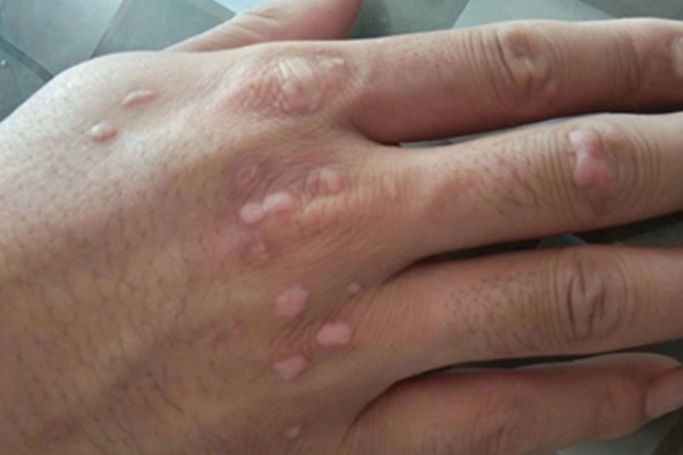 疣手背小疙瘩图 疣手背小疙瘩图