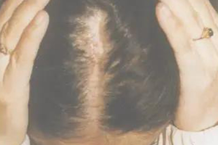 局限性硬皮病图