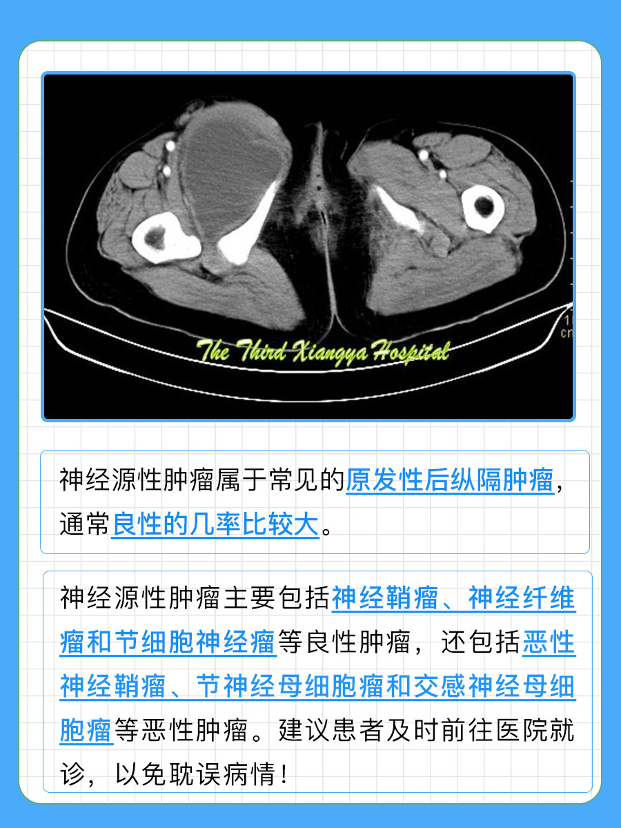 分享！神经源性肿瘤的良性几率大吗？