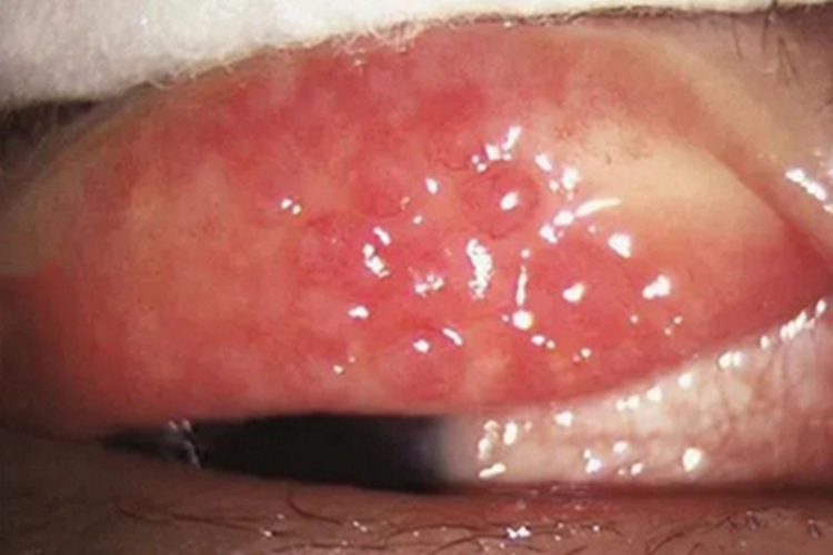 巨乳头性结膜炎眼睑红肿图