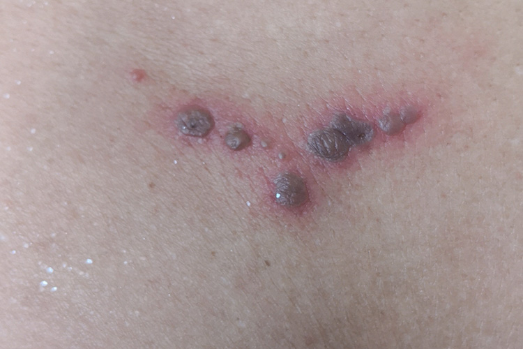 出血性带状疱疹图