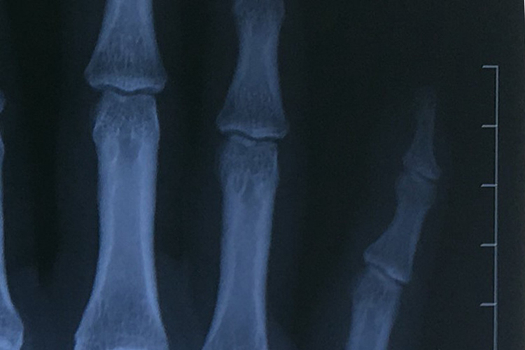 小手指关节恢复图