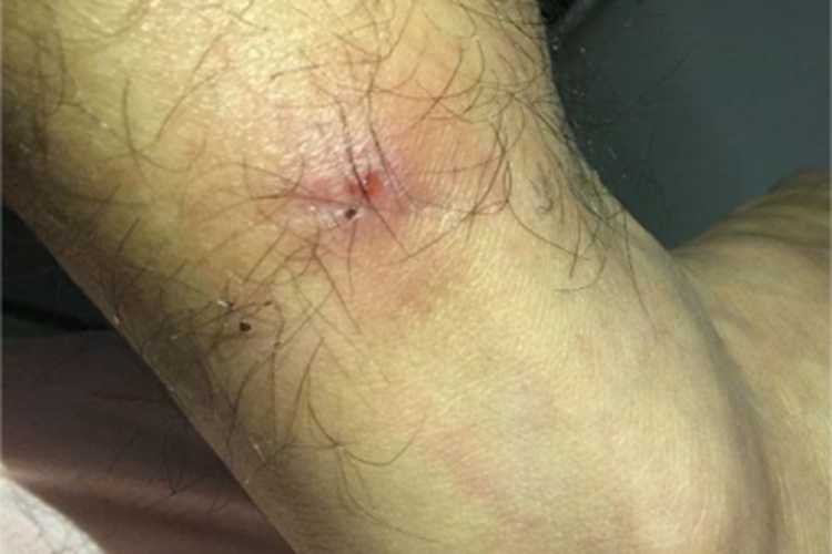 跳蚤叮咬小腿破溃结痂图