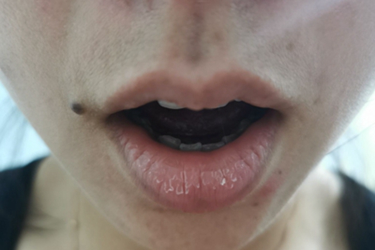 剥脱性唇炎症状图 剥脱性唇炎症状图