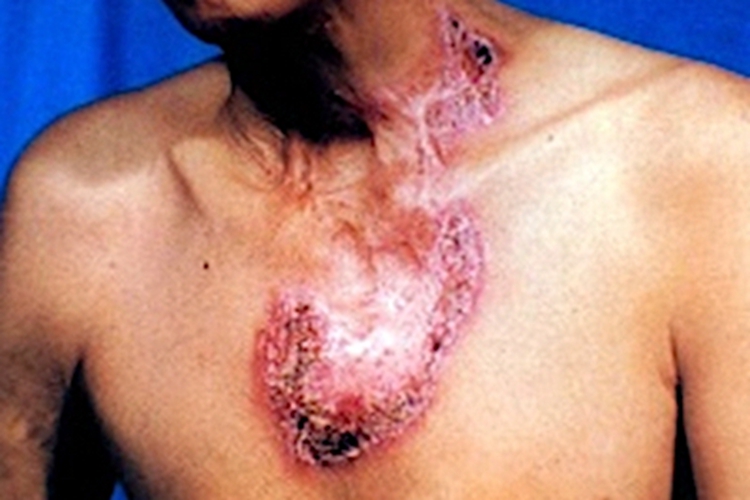 瘰疬性皮肤结核胸部结痂图 瘰疬性皮肤结核胸部结痂图