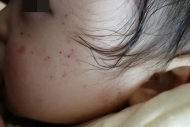 先天性风疹综合征面部症状图