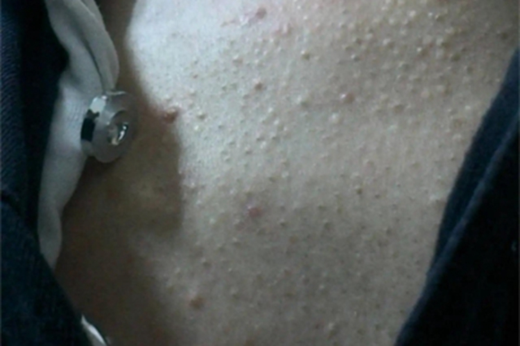 痤疮胸部长了一片黑头粉刺图