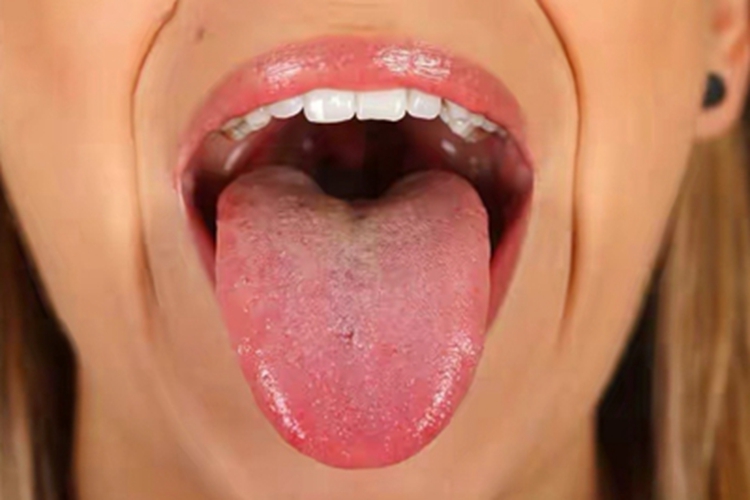 维生素B12缺乏症舌头发红图