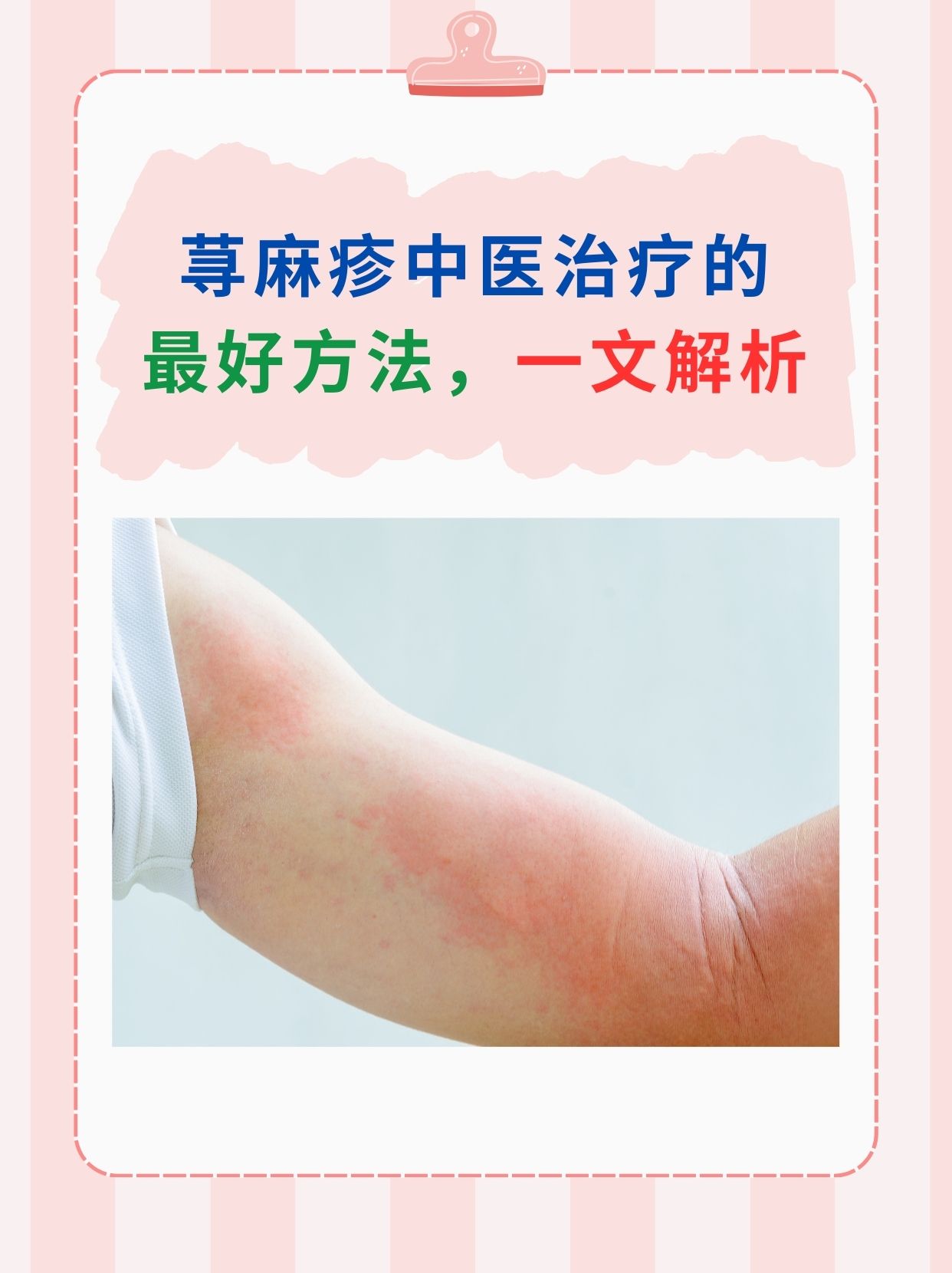 荨麻疹中医治疗的最好方法，一文解析