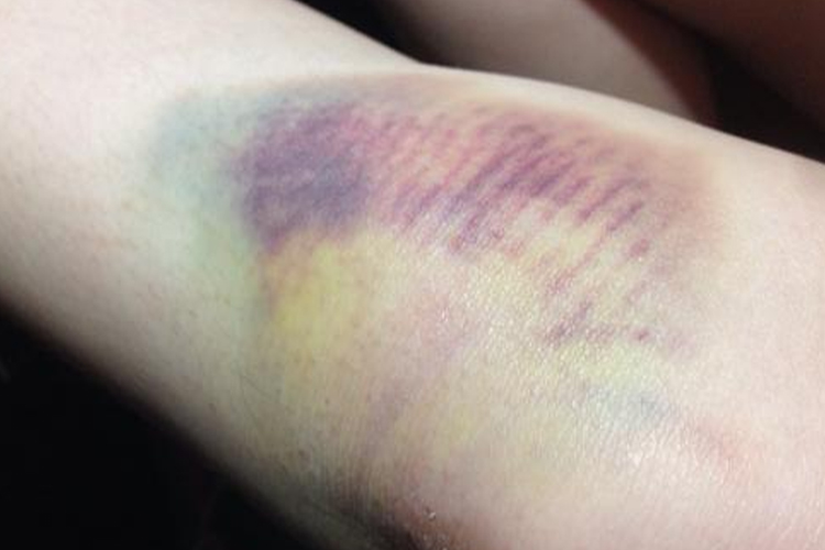 膝盖摔伤青紫淤斑图