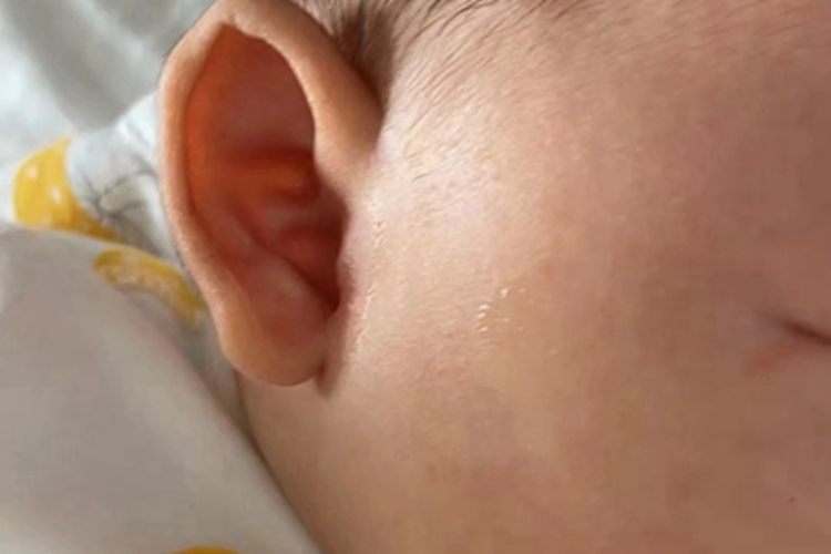 招风耳耳廓向内卷图 招风耳耳廓向内卷图